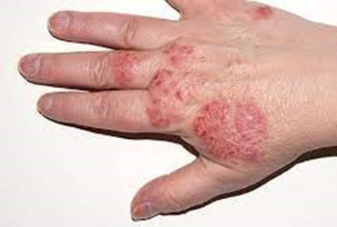 image disease covered