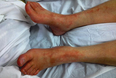 image disease covered